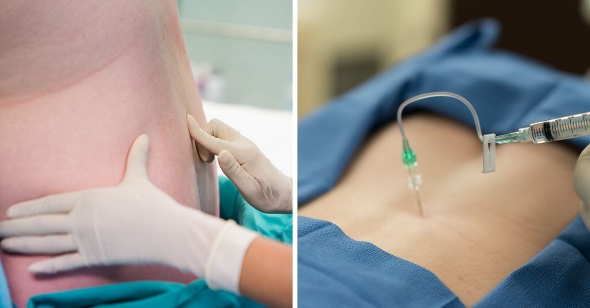 epidurale epidurale
